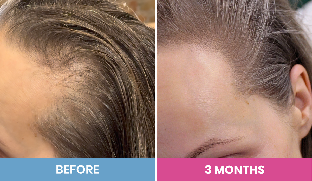 Side-by-side close-up of a persons hairline. Left side (Before) shows thinning hair; right side (3 Months) shows thicker, fuller hairline. Blue and pink labels display the timeframes.