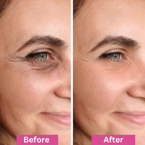 Close-up of a womans face showing the area around her eye. The left side, labeled Before, shows fine lines and wrinkles, while the right side, labeled After, shows smoother skin and reduced wrinkles.