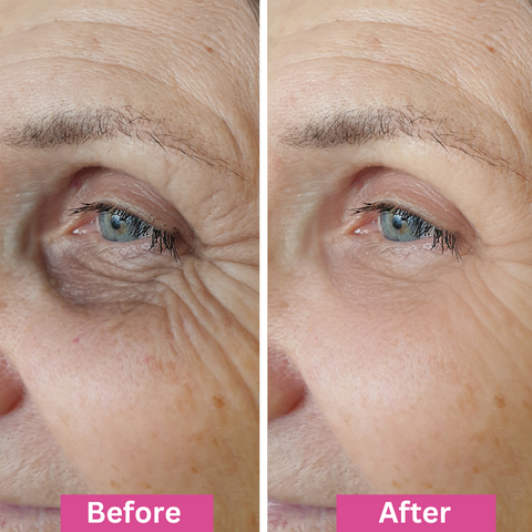 Side-by-side close-up of an older persons eye area, showing Before with visible wrinkles and under-eye bags, and After with smoother skin and reduced wrinkles. Pink labels read Before and After at the bottom.