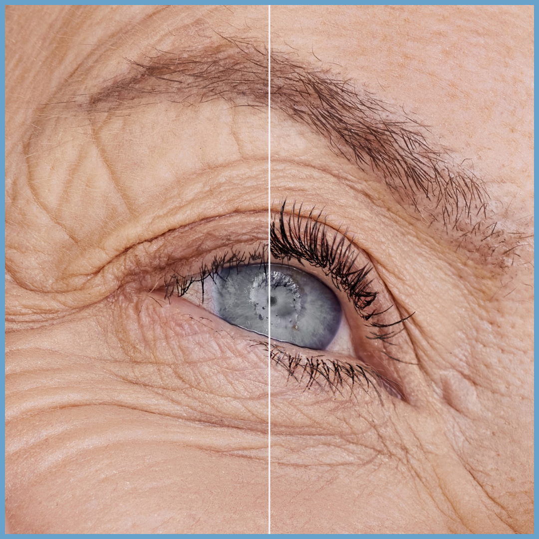 Close-up of an older persons eye and surrounding skin, divided down the middle. The left side shows more pronounced wrinkles and skin texture, while the right side appears smoother with fewer wrinkles.