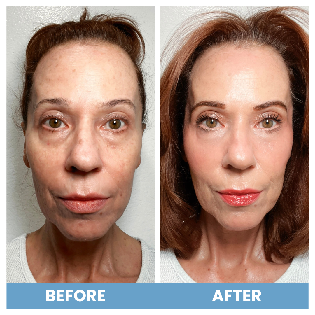 Side-by-side photos of a woman before and after a beauty treatment. In the before image, her skin appears uneven and tired. In the after image, her skin looks smoother, more refreshed, and her makeup is applied.