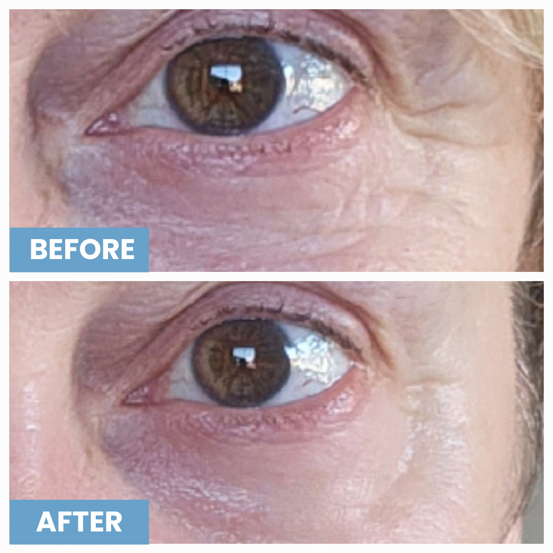 Close-up photos of a person’s eye, showing the skin under the eye. The top image is labeled BEFORE with more visible wrinkles; the bottom AFTER shows smoother, less wrinkled skin.