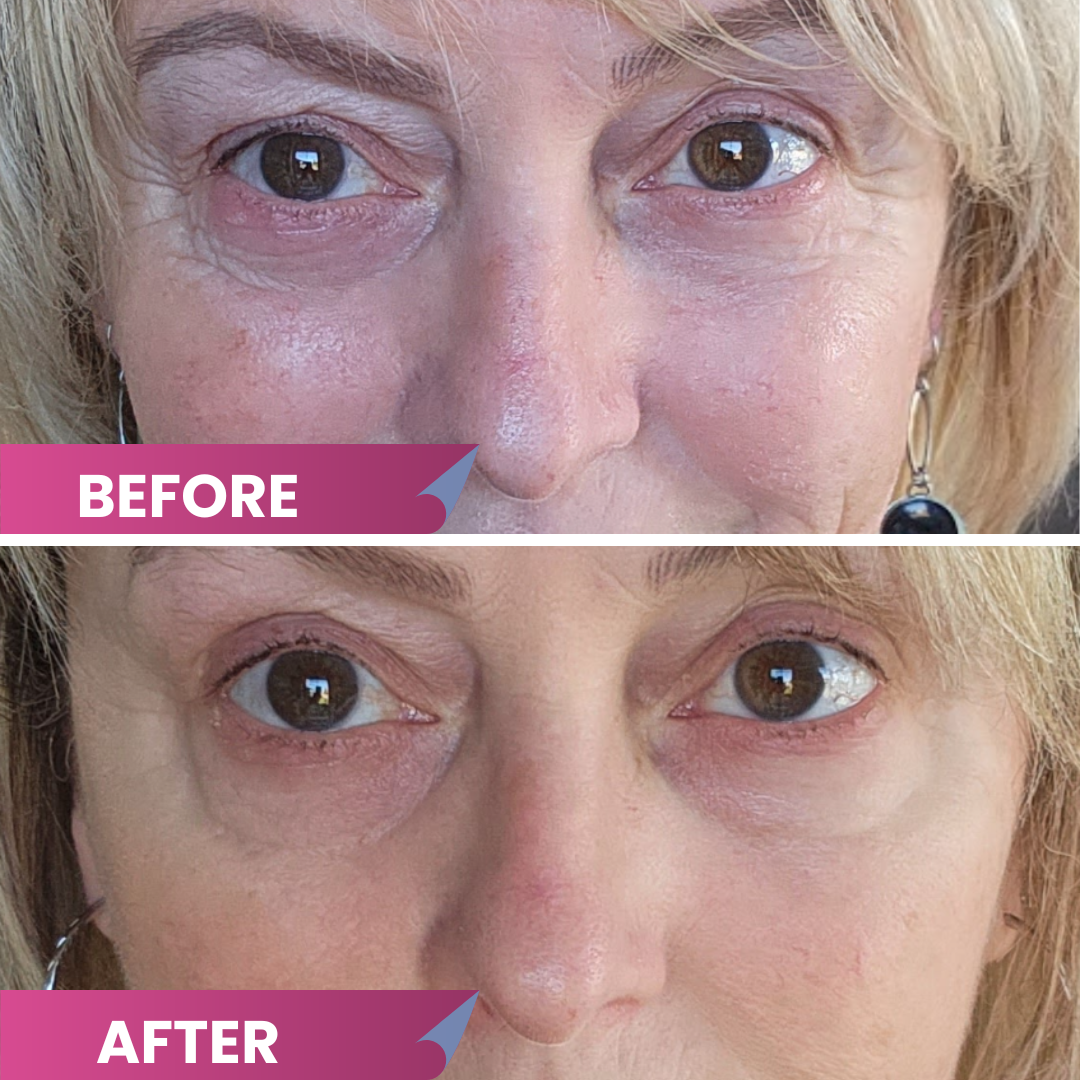 Close-up of a womans face showing her eyes and upper cheeks. The top image, labeled Before, shows more visible under-eye bags and lines. The bottom image, labeled After, shows smoother skin under the eyes.