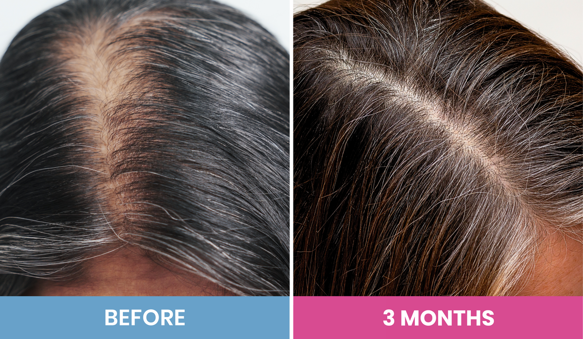 Split image showing hair regrowth: left side labeled Before with visibly thinning hair and scalp showing, right side labeled 3 Months with fuller, thicker hair and less visible scalp.
