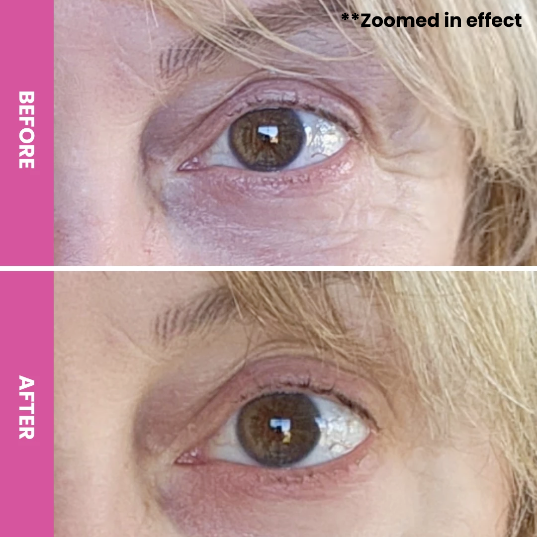 Close-up comparison of a persons eye area before and after treatment, showing reduced wrinkles and puffiness in the after image. Pink labels on the left say BEFORE and AFTER. Text in the top right reads **Zoomed in effect.