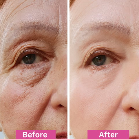 Close-up side-by-side comparison of a persons eye area showing Before with wrinkles and fine lines, and After with smoother, more youthful-looking skin. Pink labels indicate the before and after images.
