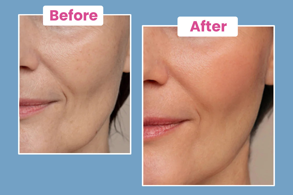 Side-by-side close-ups of a womans lower face, labeled Before and After. The After image shows smoother, more even skin tone with reduced wrinkles compared to the Before image.