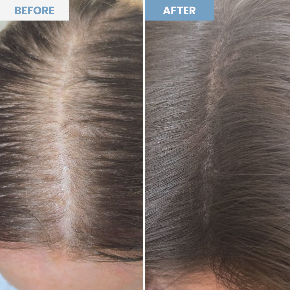 Side-by-side comparison of a persons scalp; the Before image shows thinning hair with a visible part, while the After image shows thicker hair with a less visible scalp and fuller coverage.