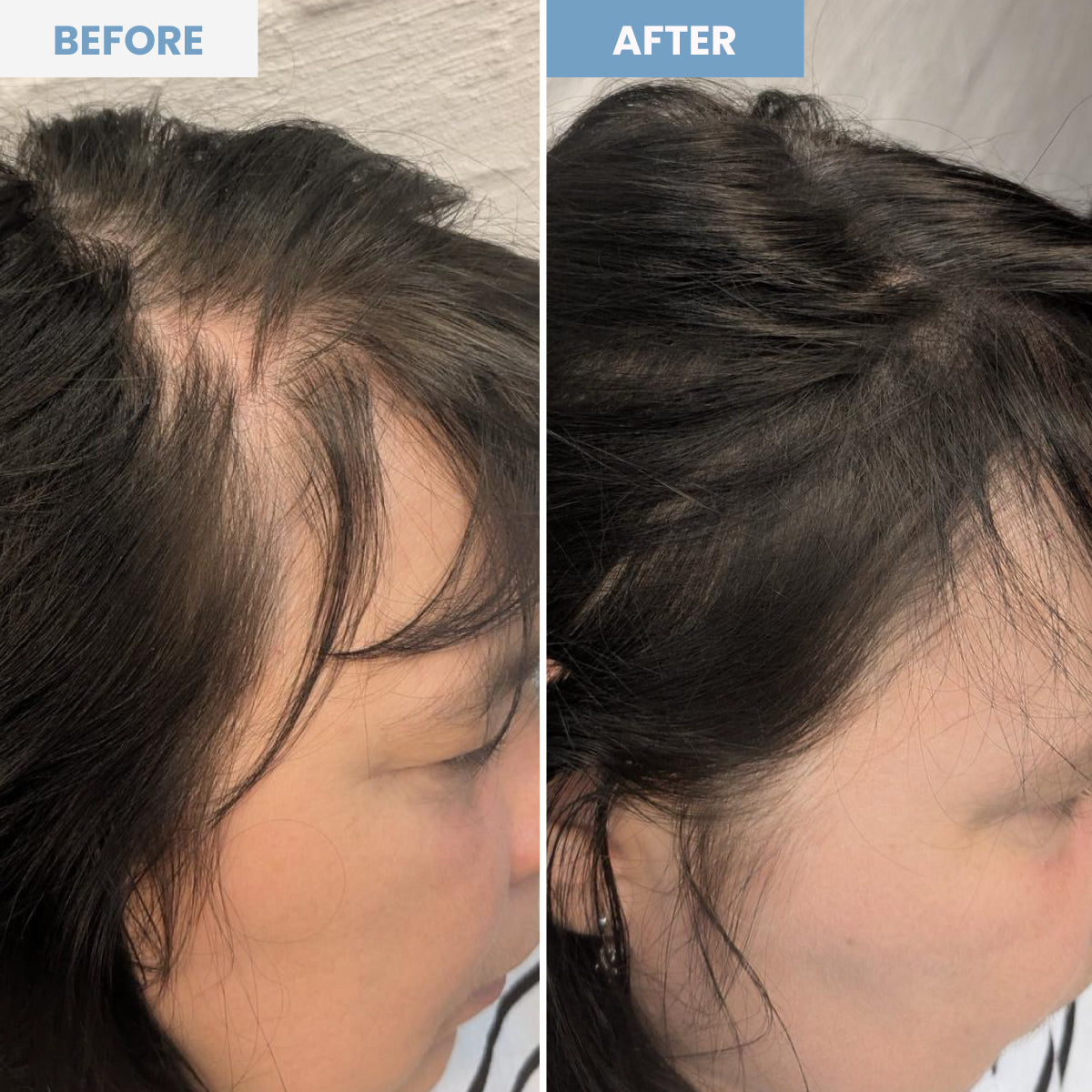 Side-by-side comparison of a womans scalp before and after treatment; the before image shows thinning hair and visible scalp, while the after image shows fuller, thicker hair with less visible scalp.