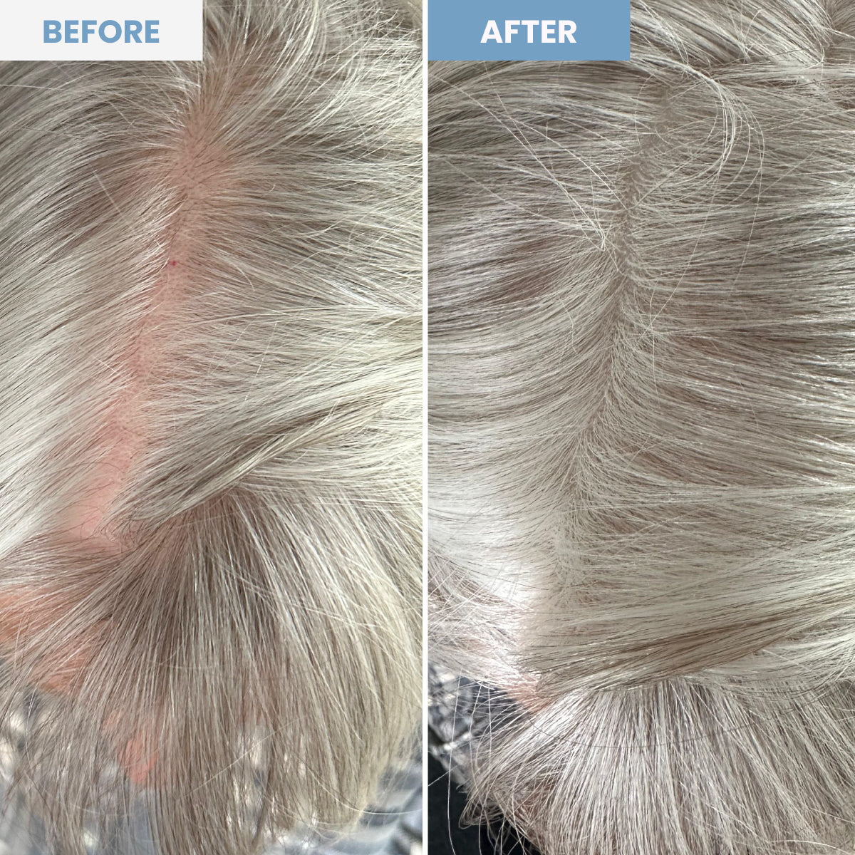 Side-by-side comparison of a scalp with thinning hair, labeled “before” on the left and “after” on the right, showing fuller, thicker hair and less visible scalp in the “after” image.