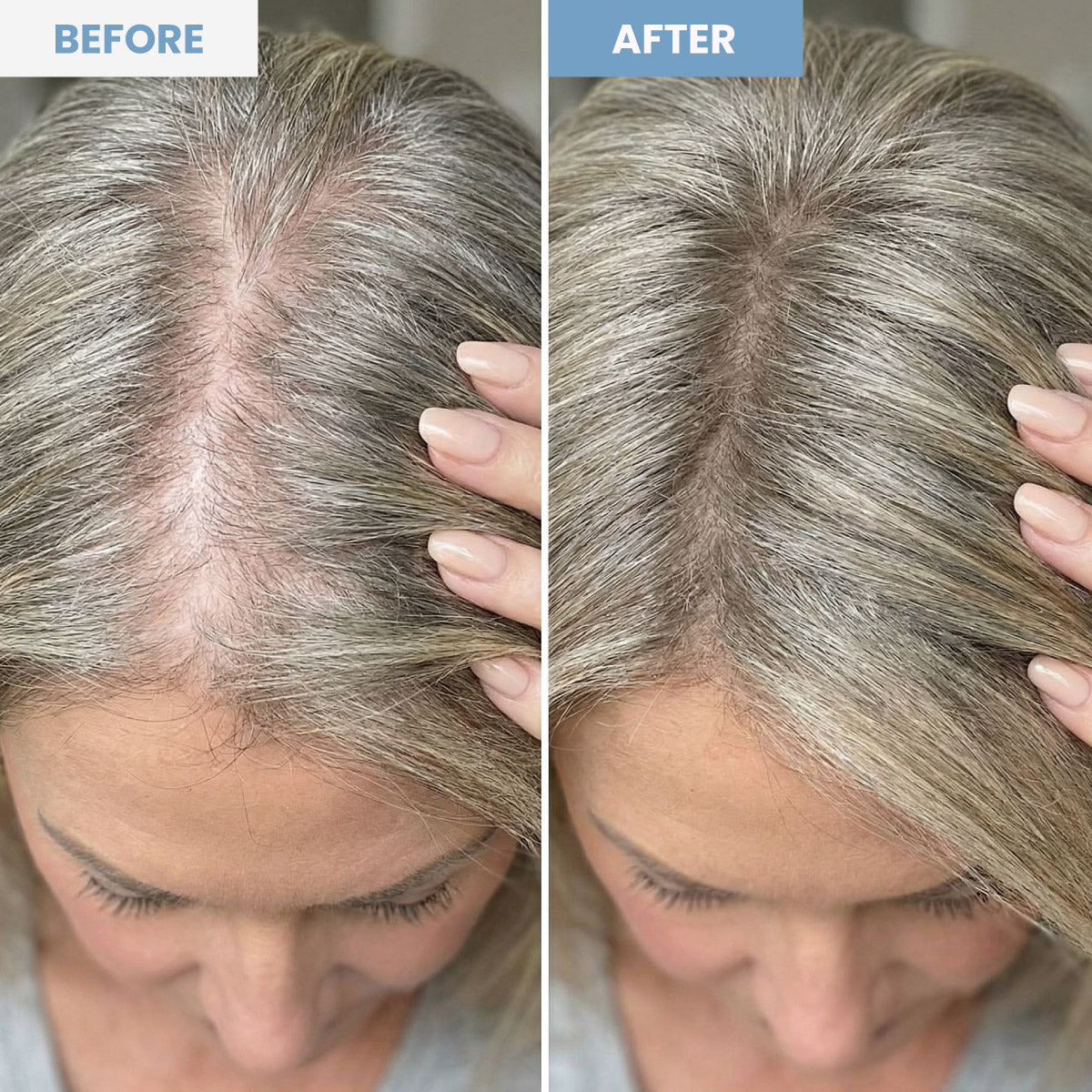 Split image showing a woman’s scalp: on the left (“before”), her hair appears thin with visible scalp; on the right (“after”), her hair looks fuller and the scalp is less visible.